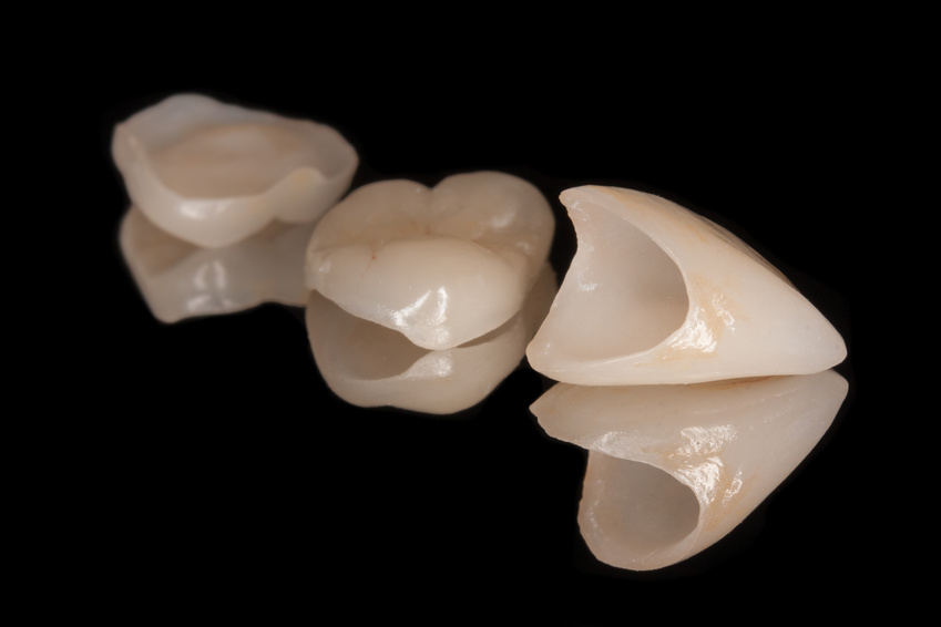 Veneers Verblendschalen für Zähne 